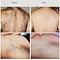 Hair Removal Laser Diode  808 Diode Laser Hair Removal